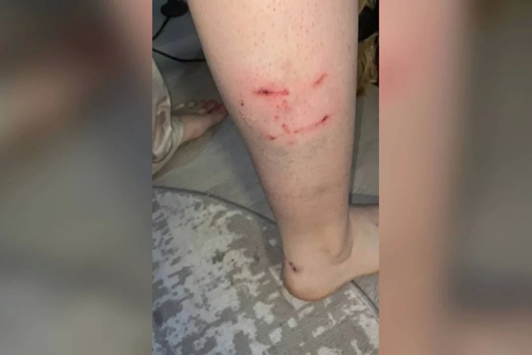 «Мама, меня собака укусила»: бродячий пес набросился на 15-летнюю школьницу по дороге на учебу