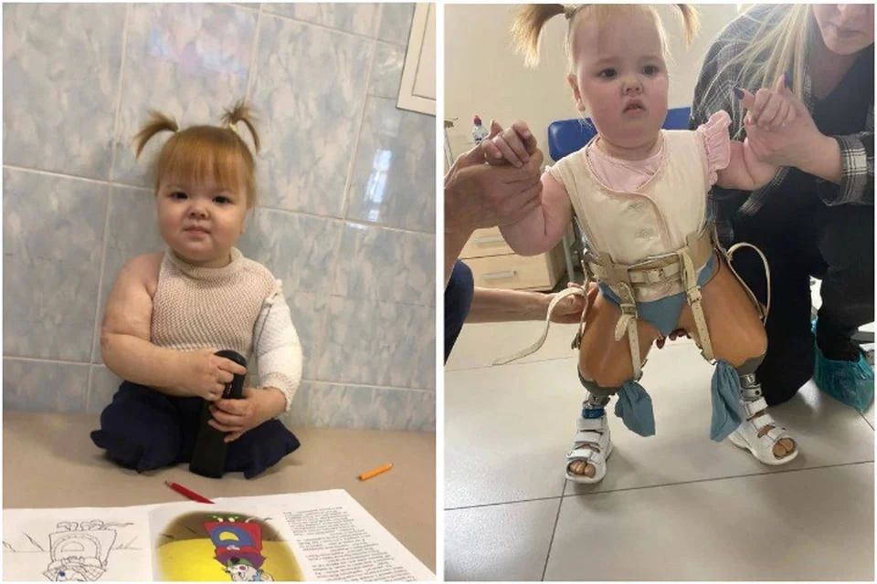 Что стало с девочкой, которая в 7 месяцев лишилась ножек из-за пожара: «Снова учится ходить»